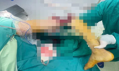 Nối thành công cẳng chân gần đứt lìa, cứu sống nam thanh niên 30 tuổi