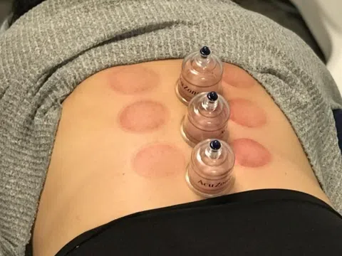 Khuyến cáo từ bác sĩ sau trường hợp nam thanh niên đột quỵ khi giác hơi tại nhà