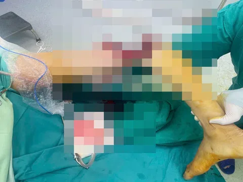 Nối thành công cẳng chân gần đứt lìa, cứu sống nam thanh niên 30 tuổi