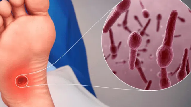 Nguy kịch vì chủ quan với vết xước nhỏ